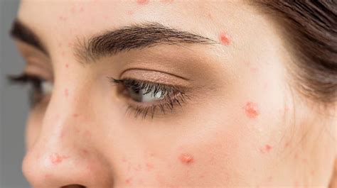 Apa itu Acnes?